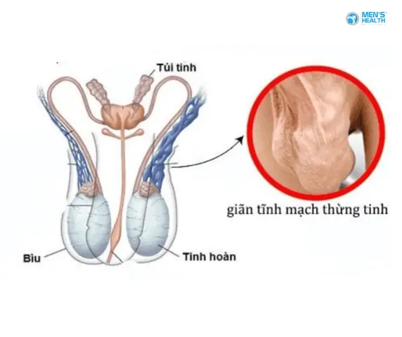 Giãn Tĩnh Mạch Thừng Tinh Có Nên Tập Gym Giãn Tĩnh Mạch Thừng Tinh Có Nên Tập Gym